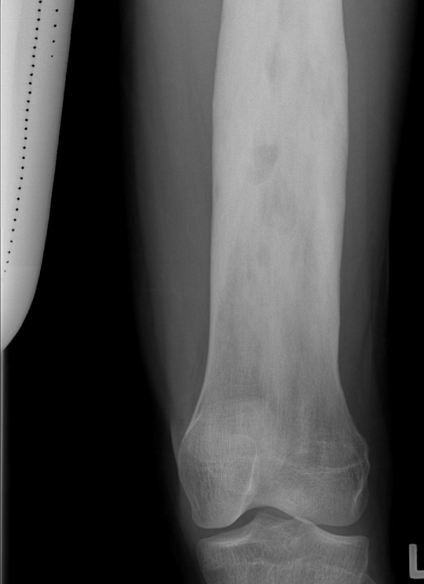 Femoral Shaft Bony Lesion